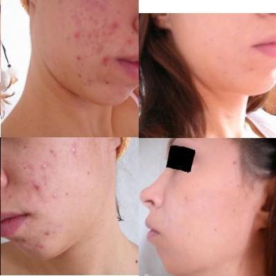 Les effets secondaires de accutane