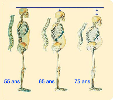 On peut à la chambre barométrique avec la varicosité